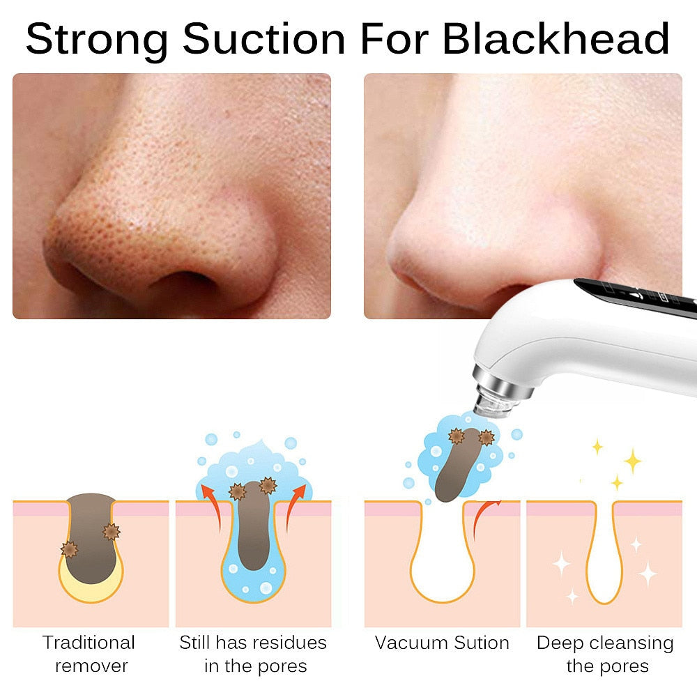 Blackhead Pore Vacuum Cleaner - Glow Formula